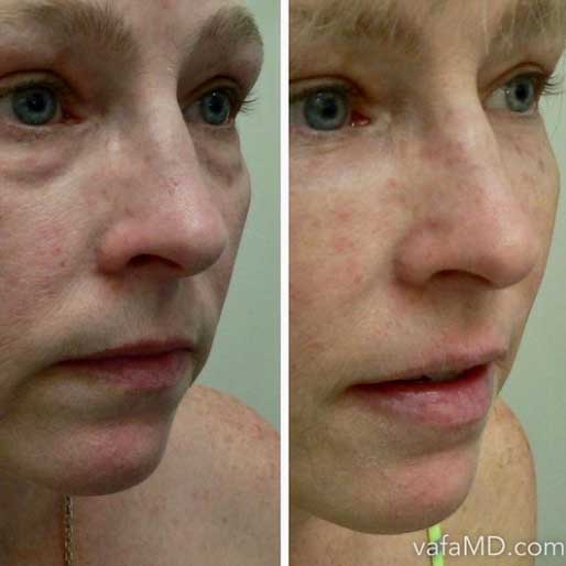 under eye dermal filler midtown manhattan nyc